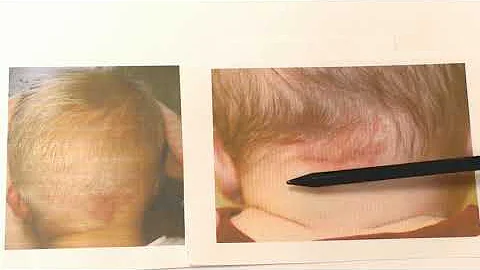 Красные сосудистые пятна у новорожденных