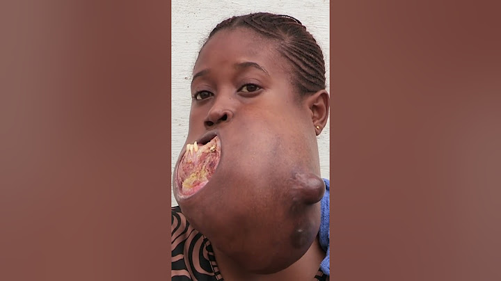 😔💔 Menina do Congo enfrenta um tumor gigante na sua mandíbula 🙌🏽💉 #MeuCorpoMeuDesafio