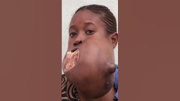 😔💔 Menina do Congo enfrenta um tumor gigante na sua mandíbula 🙌🏽💉 #MeuCorpoMeuDesafio
