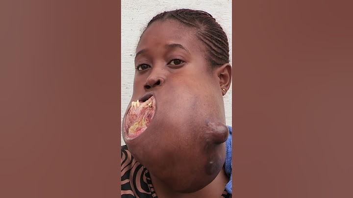 😔💔 Menina do Congo enfrenta um tumor gigante na sua mandíbula 🙌🏽💉 #MeuCorpoMeuDesafio