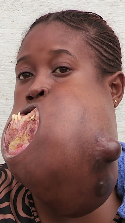 😔💔 Menina do Congo enfrenta um tumor gigante na sua mandíbula 🙌🏽💉 #MeuCorpoMeuDesafio