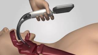 Video Laryngoscope iS3 L training video