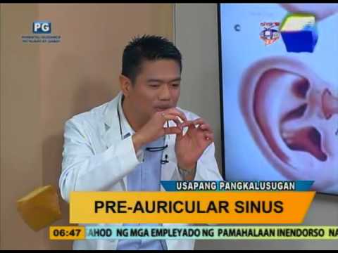 Good Morning Kuya:  Pre-auricular sinus fistula (Bizarre congenital malformation )