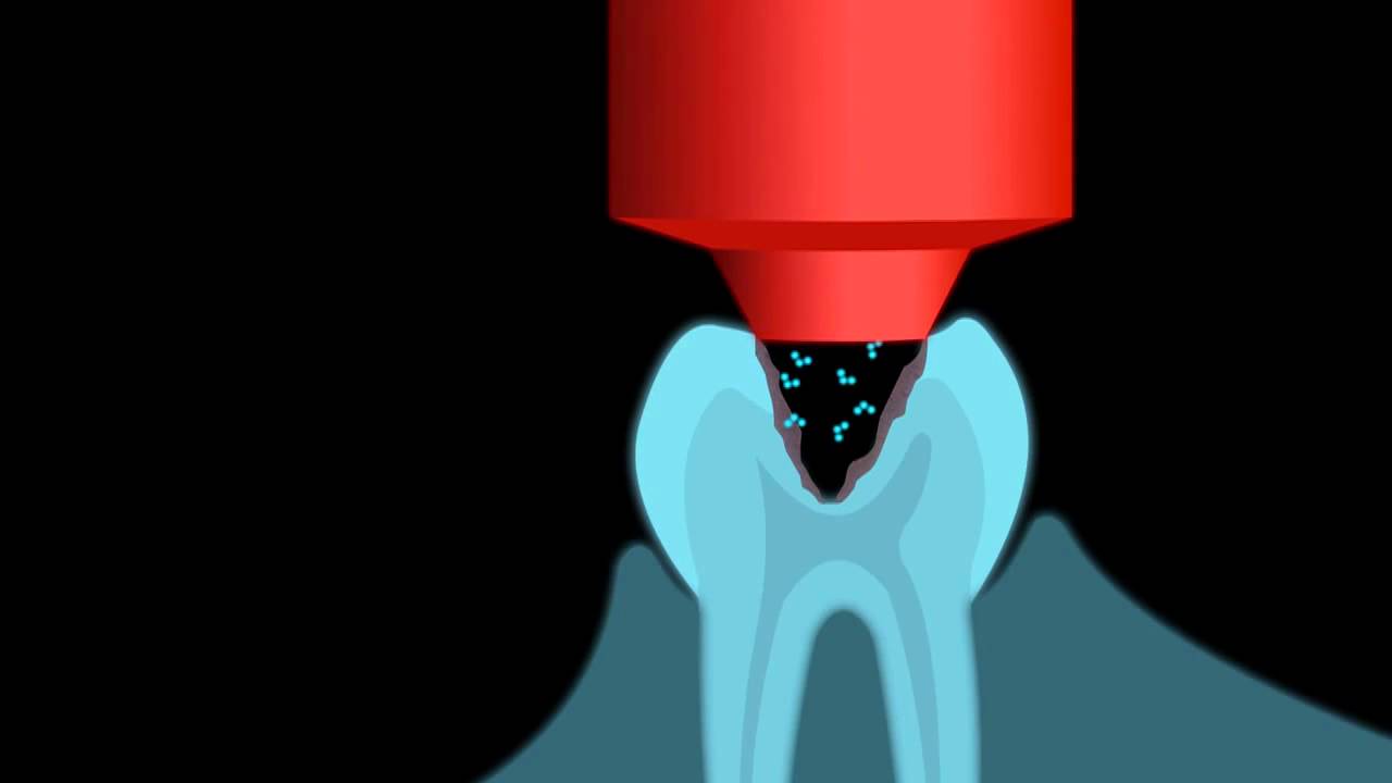 Kariesbehandlung mit Plasma