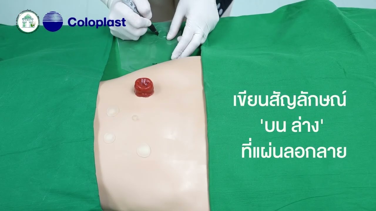 วิธีเปลี่ยนถุงรองรับสิ่งขับถ่ายจากทวารเทียม โดยชมรมพยาบาลออสโตมีและแผล โรงพยาบาลศิริราช