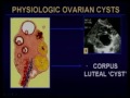 Sonographic Evaluation of the Ovary To Worry or not to Worry