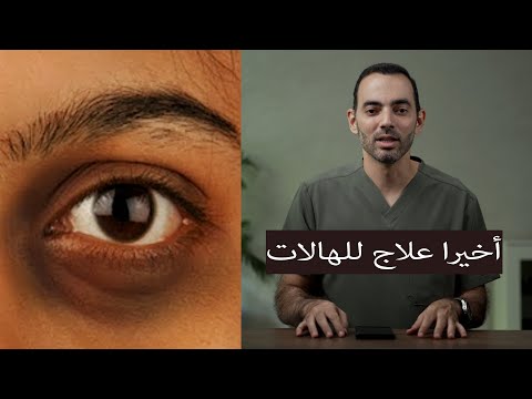 علاج جديد للهالات