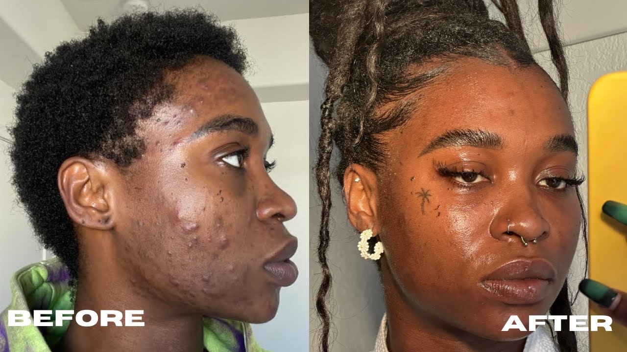 How I got rid of my Hormonal Acne \ MORNING SKINCARE ROUTINE - YouTube