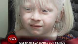 Albinismo.avi