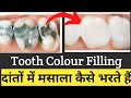 Danto Ki Filling |Danto Me Masala Kaise Bharte hai |Teeth Colour Filling |Best Teeth Filling |Cost