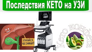 ЧТО КЕТО СДЕЛАЛО С ПЕЧЕНЬЮ И ПОЧКАМИ / ПОКАЗЫВАЮ УЗИ