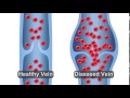 Refluxing Vein Animation Refluxing Vein Animation