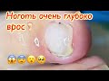 Ноготь🦶🏻который очень глубоко врос😨😱