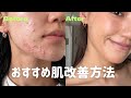 肌荒れ改善方法【ニキビ】
