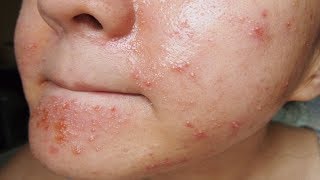 Pimples: Amazing Secrets to Treat Pimples After Waxing.