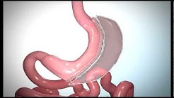 Bariatric Weight Loss - Sleeve Gastrectomy