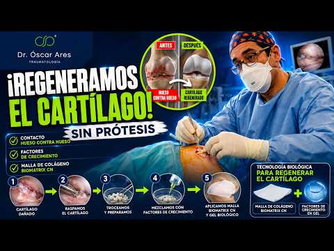 Reparación del Cartílago con malla Biomatrix CN - Dr. Oscar Ares