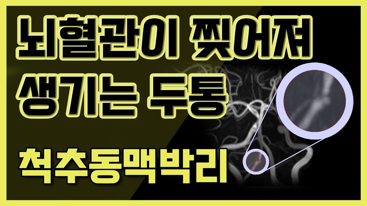 뇌혈관이 찢어져 생기는 두통 [척추동맥박리]