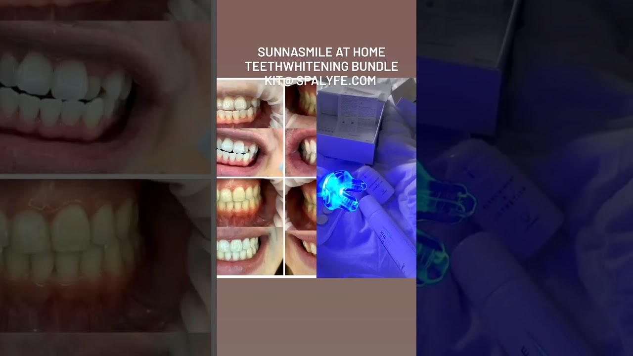 Sunnasmile At Home Teeth Whitening Kit.