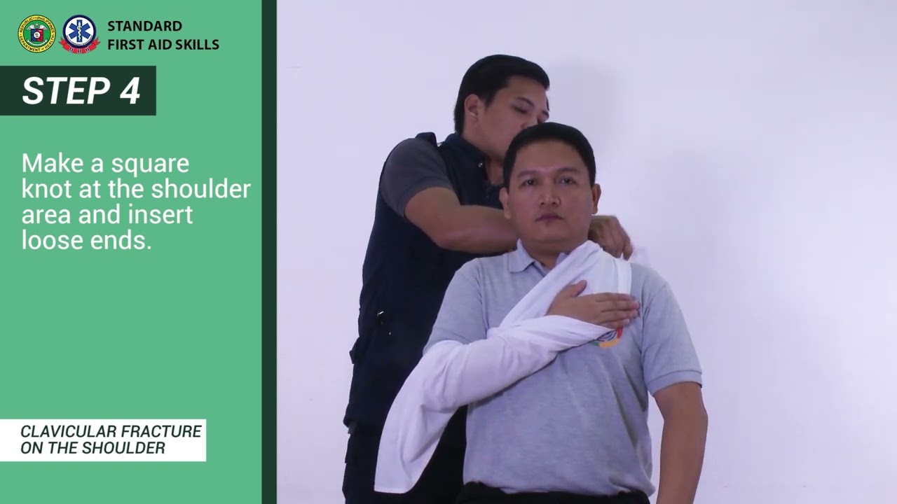 CLAVICULAR FRACTURE ON THE SHOULDER