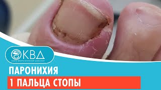 👣 Паронихия 1 пальца стопы.  Клинический случай №362