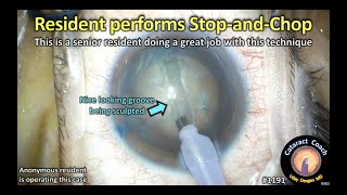 CataractCoach 1191: resident stop and chop cataract case