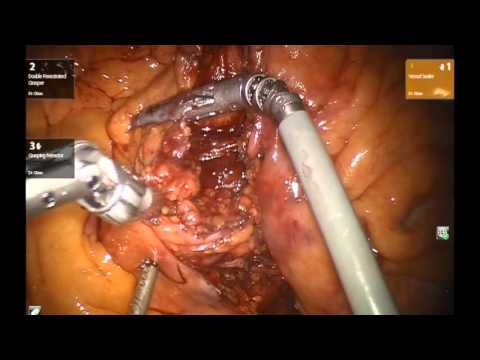 Robotic-Assisted Total Proctocolectomy With Ileal Pouch-Anal Anastomosis And Loop Ileostomy