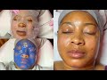 Severe Acne & Hyperpigmentation Facial Treatment | LiaLeigh