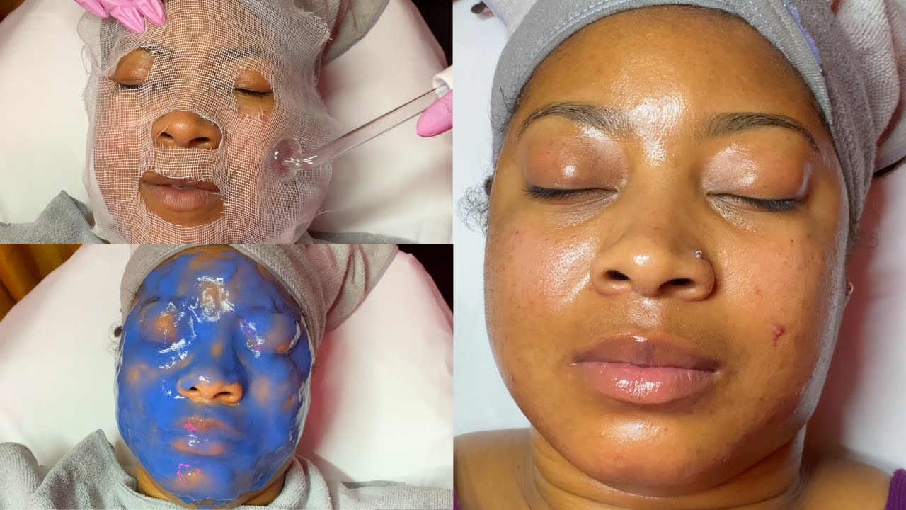 Severe Acne & Hyperpigmentation Facial Treatment LiaLeigh YouTube