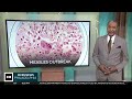 2 measles cases confirmed in Lehigh County: "This is the worst it's ever been"