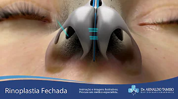 Como é feita a rinoplastia aberta?