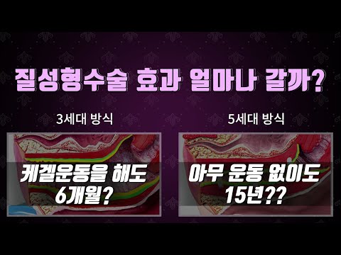 질성형(이쁜이)수술 효과 얼마나갈까? 3세대, 5세대 방식 비교  모바일비교표허가증삽입버전