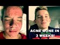 WHY DON'T DOCTORS KNOW THIS? MY SON'S ACNE HEALED!! (OUR STORY)