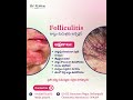 Folliculitis Treatment | Hair Follicle Infection Care | Sri Krishna Hospital Mancherial