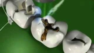 Kids Dental Caries(, 2009-12-29T07:51:29.000Z)