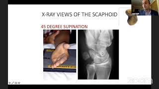 Scaphoid fracture and SNAC wrist by Dr Saurabh Aggarwal Complex Distal Radius Fractures By Dr Saurabh Aggarwal