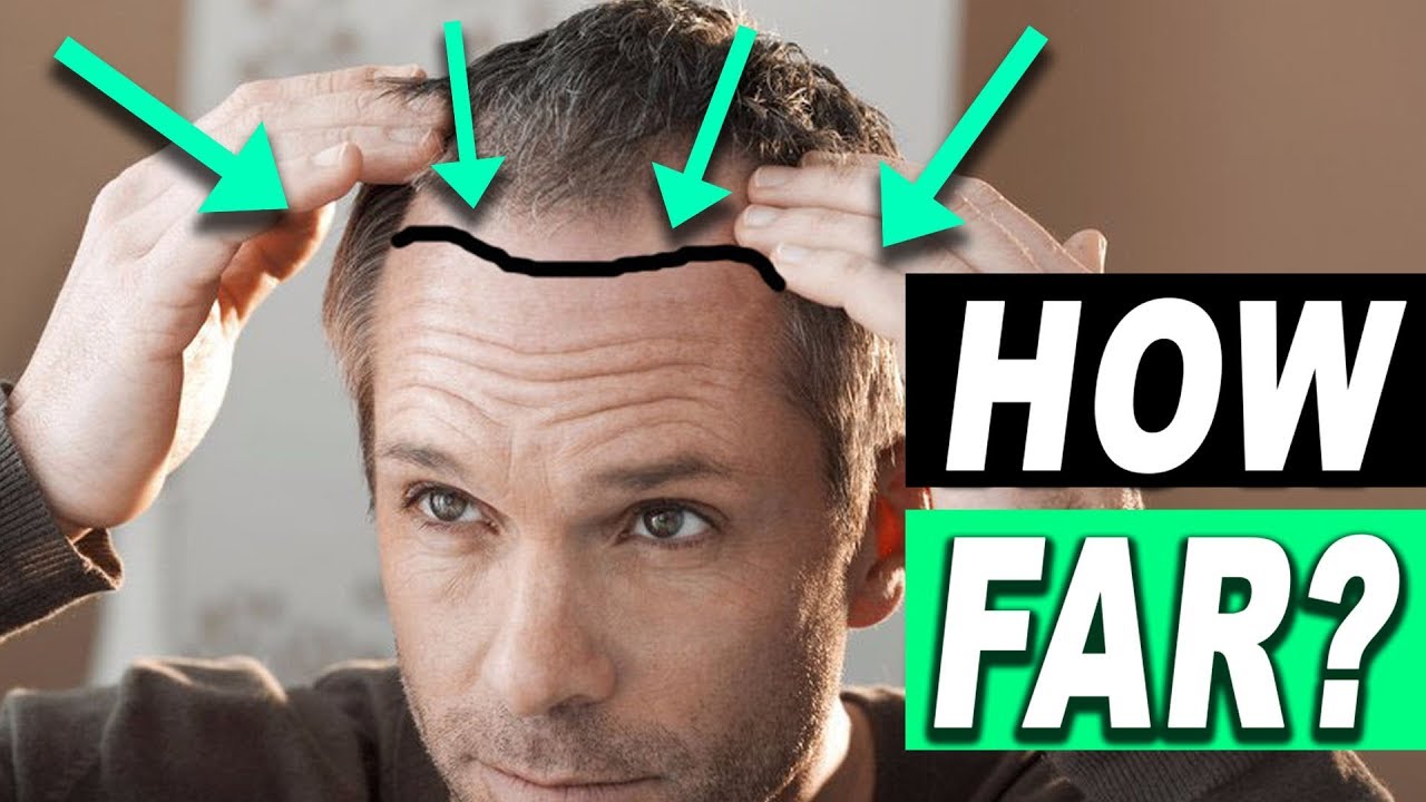 How Far Can You Move Your Hairline With Hair Transplant? - YouTube