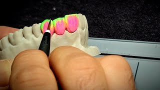 Build up Upper anterior teeth..بناء الخزف للأسنان الأمامية العلوية