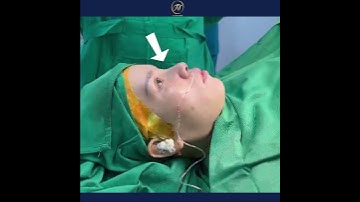 #106 NÂNG MŨI CẤU TRÚC SURGILINE CÓ GÌ HAY MÀ CHỊ EM MÊ ĐẾN THẾ | DR.TRUNG NGUYỄN