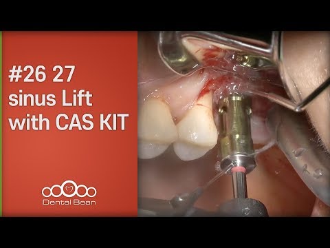#26 27 sinus Lift with CAS KIT