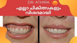 Gummy smile treatment in malayalam | gummy smile | gummy smile treatment | malayalam | surgery