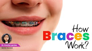How Braces Work and Role of Orthodontic Treatment | Dr. Kavita Lamba, Senior Dentist
