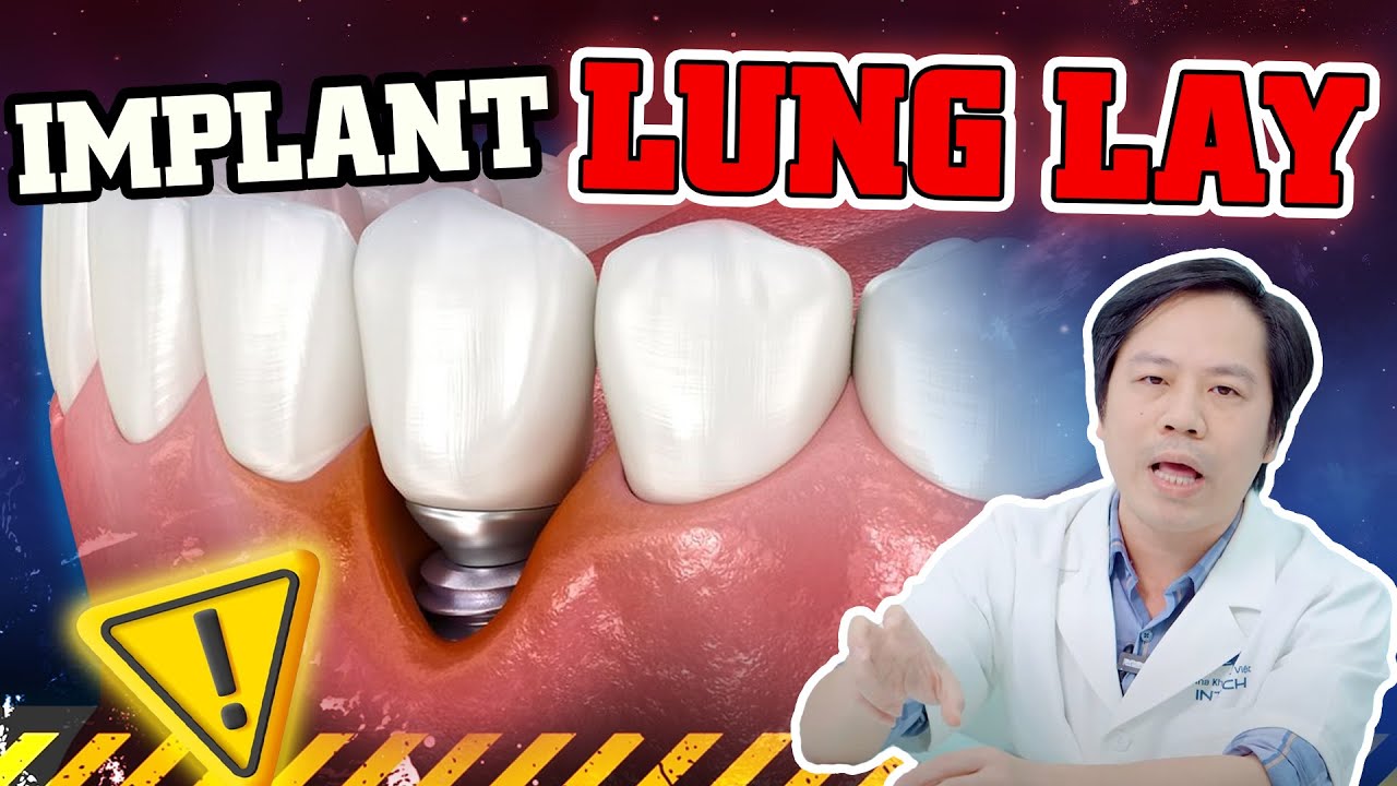 Outline Video Răng Implant Bị Lung Lay: 3 Nguyên Nhân "Không Tưởng" Và Cách Khắc Phục Ngay Lập Tức!