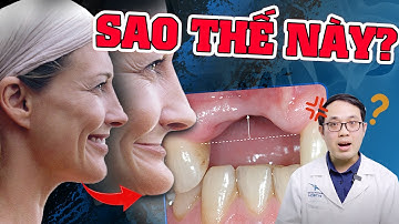Tiêu Xương Hàm: 3 Ảnh Hưởng Cực Nghiêm Trọng Của Tiêu Xương Hàm| Cách Xác Định Bị Tiêu Xương Hàm?