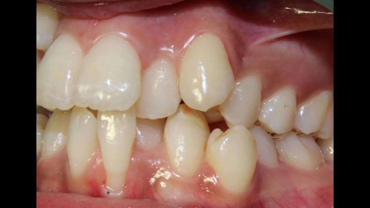 T Loop mechanics, Canine retraction, lower incisor extraction 