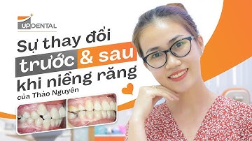 Hình ảnh trước và sau khi niềng răng khấp khểnh của Thảo Nguyên