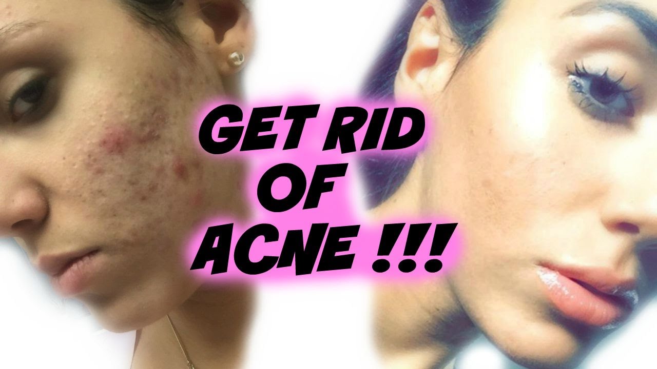 How To Get Rid Of Acne Fast + Easy