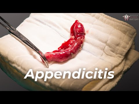 What Causes Appendicitis x How To Treat It