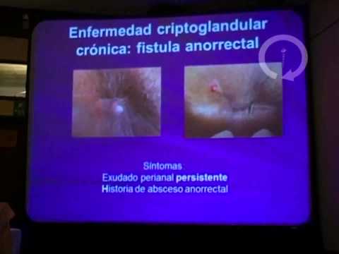 Abscesos Anales y Fistulas