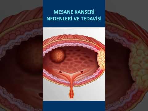 MESANE KANSERİ